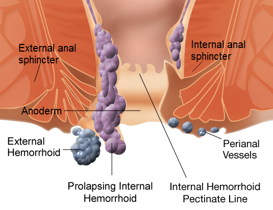 Buasir-Internal_and_external_hemorrhoids