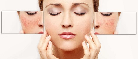 cara hilangkan sunburn